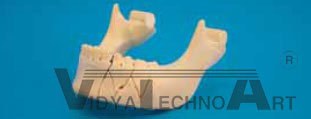 Mandible, fractured, Clip